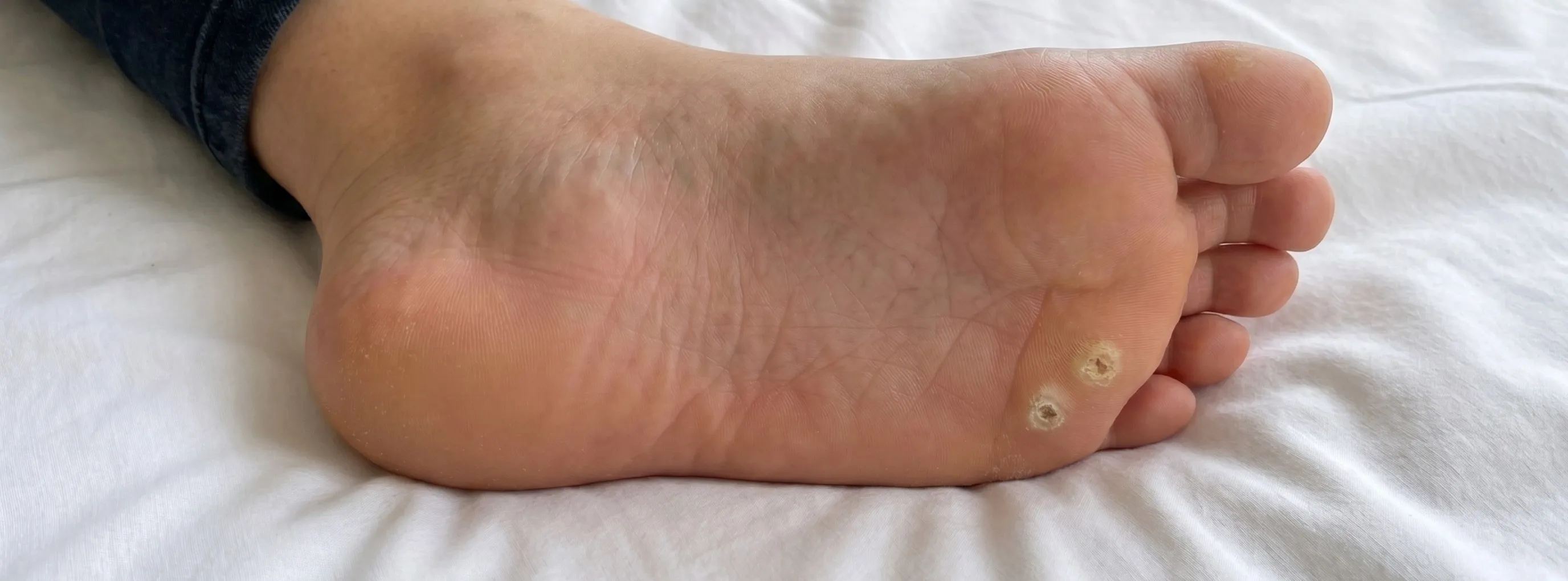 Lesão na sola do pé característica de olho de peixe ou verruga plantar