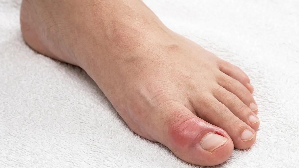 Cuidados clínicos para cicatrização de unha inflamada e infeccionada no dedo do pé